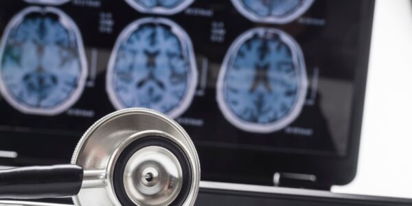 Cientistas descobrem a causa da progressão do Alzheimer no cérebro